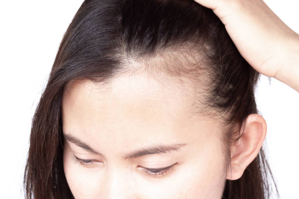 Woman serious hair loss problem for health care shampoo and beauty product concept, selective focus Woman serious hair loss problem for health care shampoo and beauty product concept, selective focus balding photos stock pictures, royalty-free photos & images