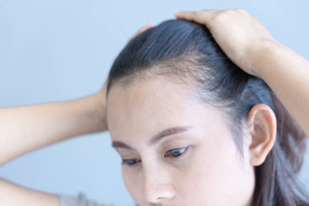 Female Pattern Hair Loss: Diagnosis & Treatment Options