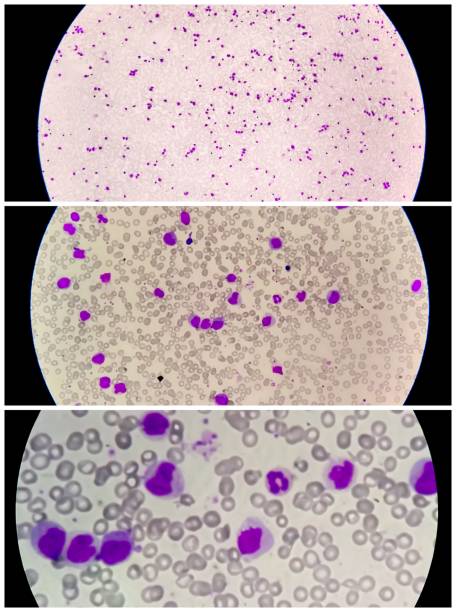 감기 아글루티닌 질환(cad), 자가면역 혈혈성 빈혈의 현미경 보기 - leukemia pathologist blood hematologist 뉴스 사진 이미지