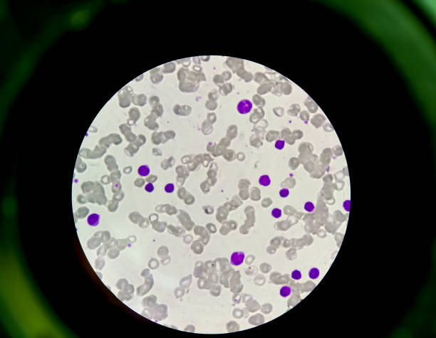 감기 아글루티닌 질환(cad), 자가면역 혈혈성 빈혈의 현미경 보기 - leukemia pathologist blood hematologist 뉴스 사진 이미지