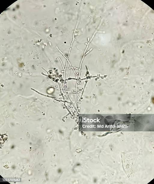 Infeksi Ragi Infeksi Jamur Pemula Ragi Dan Pseudohyphae Dari Candida Albicans Jamur ...