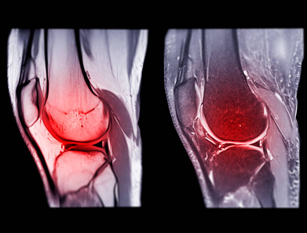 Magnetic resonance imaging or MRI knee comparison sagittal PDW and TIW view for detect tear or sprain of the anterior cruciate  ligament (ACL). stock photo