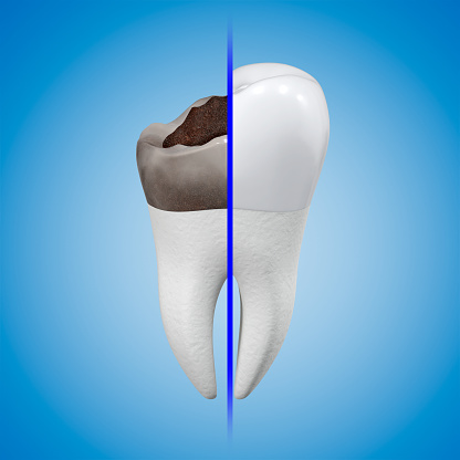 The concept of prosthetics for a damaged tooth with a metal-ceramic crown. Carious tooth and dental crown. Dental theme. 3d rendering.