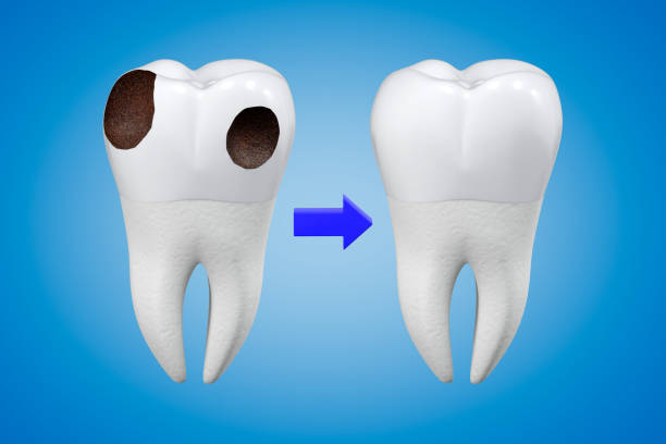 istock Carious tooth treatment concept. A tooth with decay and a healthy tooth. 3d rendering. 1323733990
