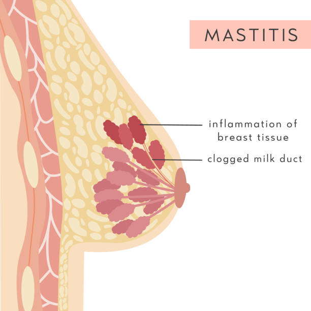 Medical Infographic of Mastitis disease. Cross Section of Female Breast with tissue inflammation. Anatomy of Woman Chest. Mammary gland. Information card. Vector illustration in flat style. Medical Infographic of Mastitis disease. Cross Section of Female Breast with tissue inflammation. Anatomy of Woman Chest. Mammary gland. Information card. Vector illustration in flat style female rib cage stock illustrations