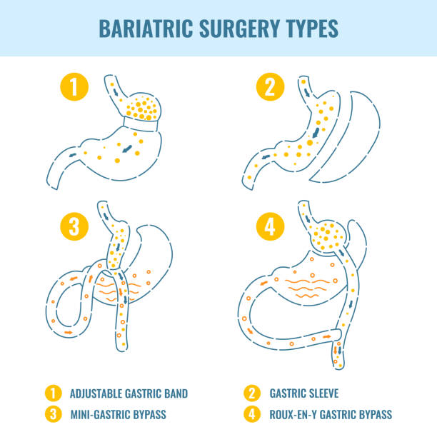 Bariatric surgery weight loss procedure types infographics Types of bariatric surgery weight loss procedures- gastric bypass, sleeve gastrectomy, adjustable gastric band. Stomach medical diagram infographics in line style. Vector illustration. jejunum stock illustrations