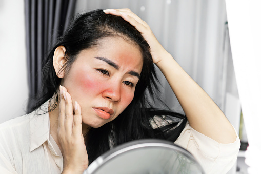 Mujer asiática que tiene problemas con quemaduras solares en la cara, revisando su piel enrojecimiento en un espejo photo