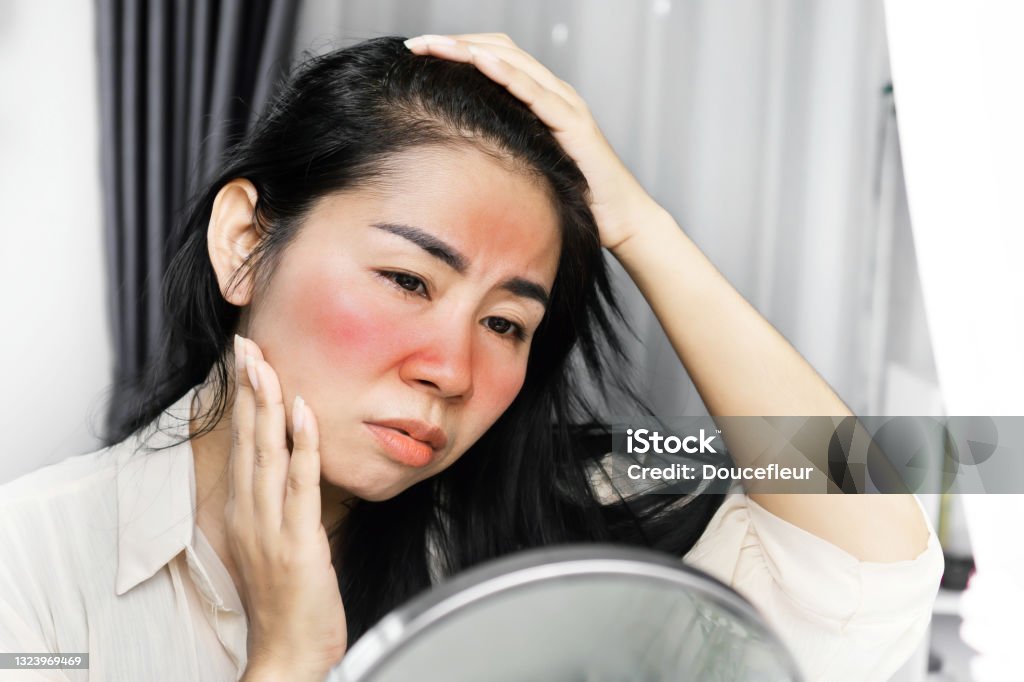 Asian woman having problem with sunburn on face , checking her redness skin on a mirror sad Asian woman having problem with sunburn on the face, checking her redness skin on a mirror because of ultraviolet from sunlight Human Face Stock Photo
