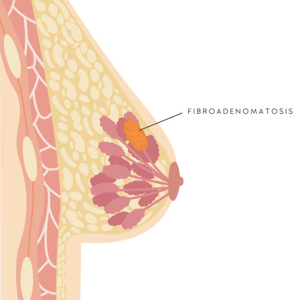 illustrazioni stock, clip art, cartoni animati e icone di tendenza di sezione medica infografica del seno femminile con fibroadenomatosi. scheda informativo con lesione mammario benigna. fibroadenoma. anatomia del petto della donna. ghiandola mammaria. illustrazione vettoriale. - areola