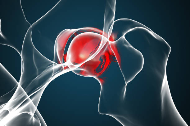 Real X-ray image of a human hip with severe osteoarthritis.These hip was replaced by an artificial joint