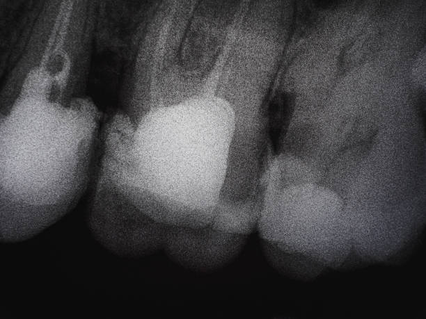 istock dental x-ray of several bad molars. caries 1324050101