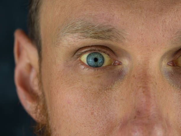 homem olhos obstrutivo jaundice amarelo descoloração real pessoas disfunção hepática icterus com sintoma de hepatite cirrose - yellowing - fotografias e filmes do acervo