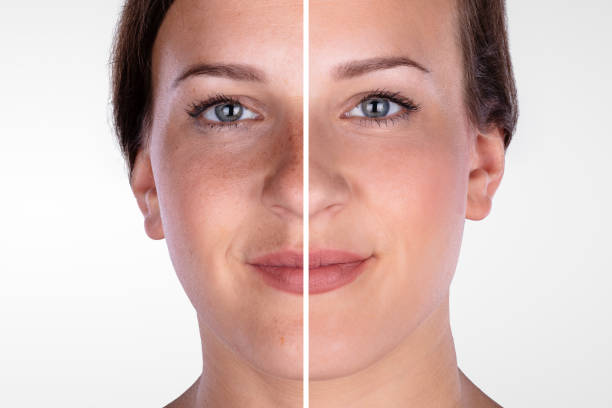 faccia da donna prima e dopo la procedura cosmetica - microdermabrasion foto e immagini stock