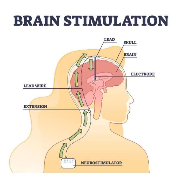 procedura głębokiej stymulacji mózgu edukacyjny opis zarysu - electrode stock illustrations