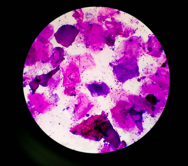 istock Urethral Smear or discharge microscopic show epithelial cells and Gram-positive cocci include Staphylococcus aureus which is causes for infection of patients. 100x objective. 1324254101