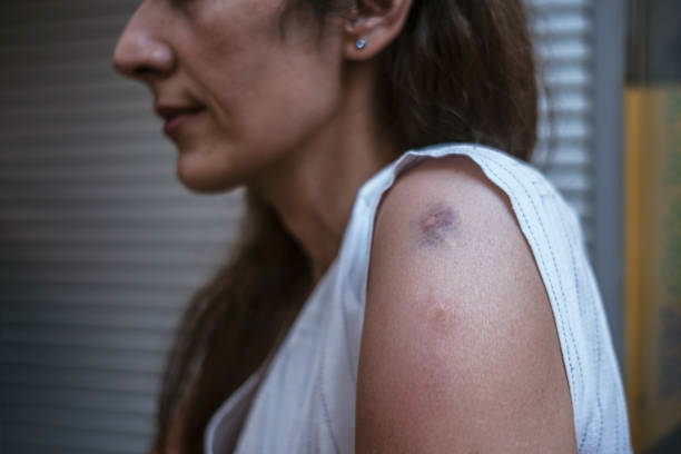istock Skin Reaction After Vaccination on a Woman's Arm. 1324255400