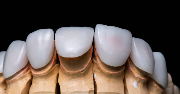 istock press ceramic crowns and veneers bleach color 1324396016