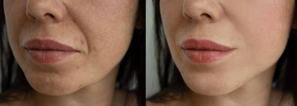 istock woman face wrinkles before and after treatment 1324425620