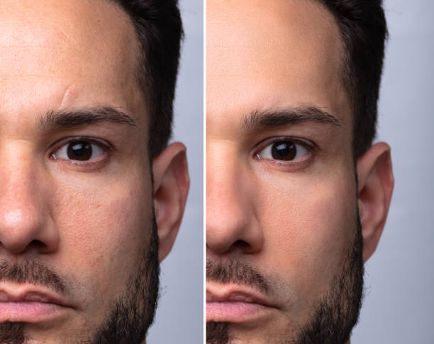 istock Man's Face Before And After Cosmetic Procedure 1324470716