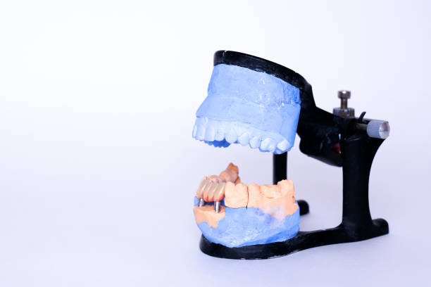 istock Veneers and crowns on gypsum dental artificial jaw on grey background. Working demountable plaster model of teeth. White front teeth veneers on diagnostic model. Concept of aesthetic dentistry. Concept of new healthy smile. restoration of teeth. new teeth 1324615541
