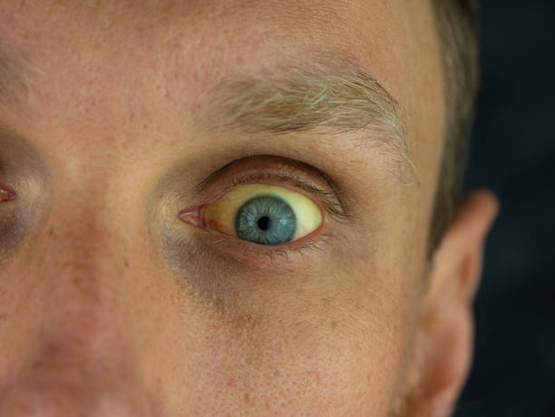istock Man eyes obstructive Jaundice yellow discoloration Real people liver dysfunction icteruswith cirrhosis hepatitis symptom 1324663221