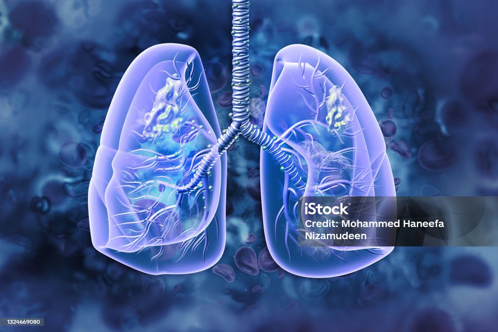 Lung cancer. lung disease. 3d illustration Lung Cancer Stock Photo