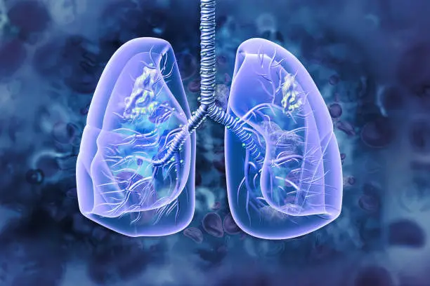 Photo of Lung cancer. lung disease. 3d illustration