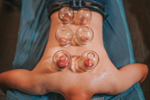 direkt über asiatischen chinesischen männlichen patienten erhalten vakuum schröpfen therapie behandlung in der chinesischen medizin-klinik - acupuncture cupping stock-fotos und bilder