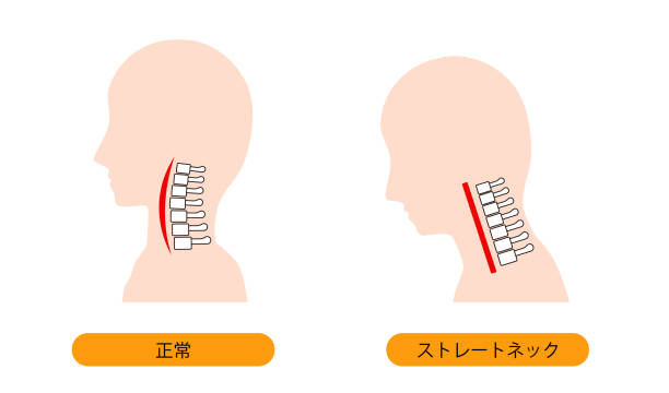 これは、ストレートネック(テキストネック)と通常の首の骨のイラストです。 - 人体図点のイラスト素材／クリップアート素材／マンガ素材／アイコン素材