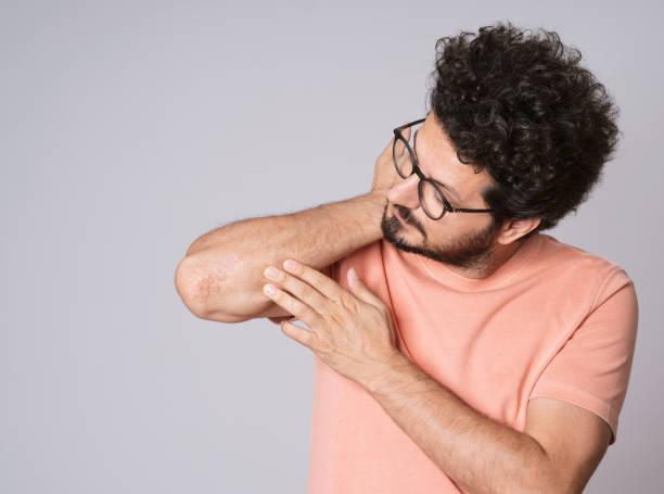 man with psoriasis on his elbows - elbow imagens e fotografias de stock