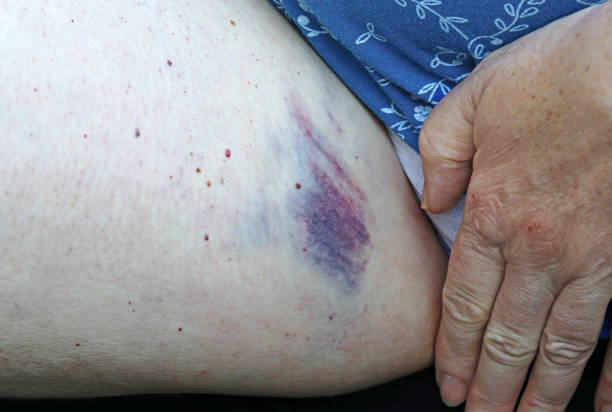 istock A woman has a large painful bruise (bruise) on her inner thigh 1324785553