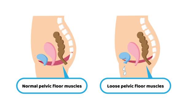 illustrazioni stock, clip art, cartoni animati e icone di tendenza di meccanismo di perdita delle urine illustrazione medica dei muscoli del pavimento pelvico - human groin