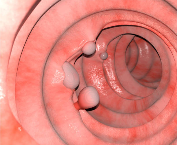 istock 3d Illustration of the Intestinal Polyps 1324922971