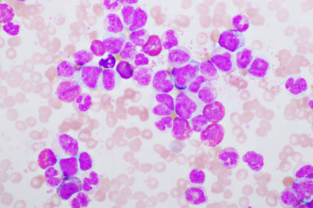 istock Chronic myeloid leukemia cells or CML 1325073069