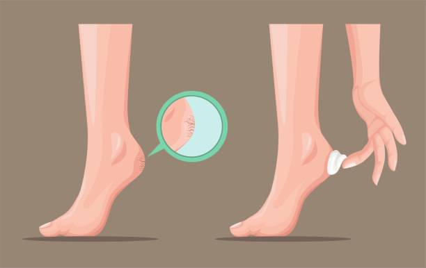 ilustraciones, imágenes clip art, dibujos animados e iconos de stock de callus agrietado talón agrietado y loción de la piel crema concepto de producto en la historieta vector de ilustración realista - human foot