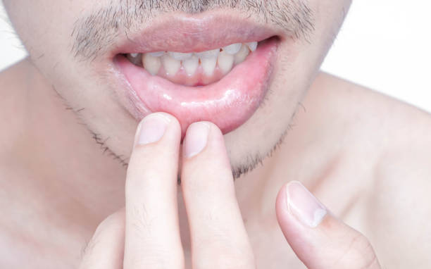 istock Closeup of lips man problem health care, Herpes simplex 1325514369
