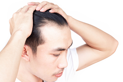 Young Man Serious Hair Loss Problem For Health Care Medical And Shampoo Product Concept Stock Photo - Download Image Now - iStock Young Man Serious Hair Loss Problem For Health Care Medical And Shampoo Product Concept Stock Photo - Download Image Now - iStock