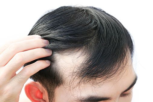 Young Man Serious Hair Loss Problem For Health Care Shampoo And Beauty  Product Concept Stock Photo - Download Image Now - iStock
