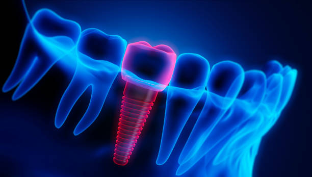 Medical Visualization - Dental Implant in the Jaw Close-up of a dental implant with crown in the lower jaw against a dark background - X Ray 3D illustration scientific imaging technique stock pictures, royalty-free photos & images