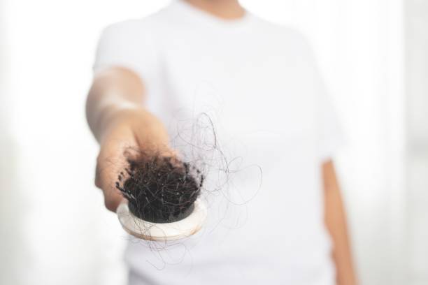 istock Women are allergic to shampoo causing hair loss and dandruff. 1325678049