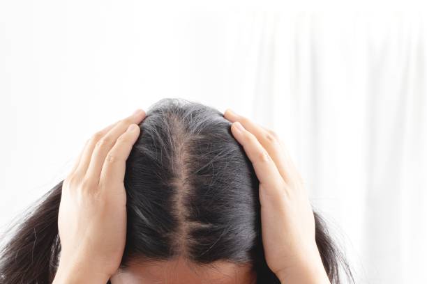 istock Women are allergic to shampoo causing hair loss and dandruff. 1325678073