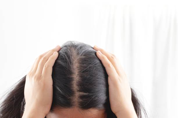 Women are allergic to shampoo causing hair loss and dandruff. stock photo