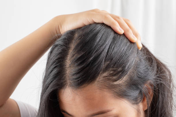 istock Women allergic to shampoo causing hair loss, baldness, dandruff 1325727870