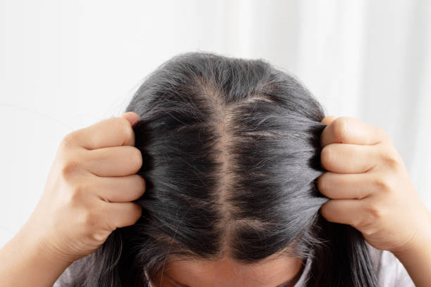 istock Women allergic to shampoo causing hair loss, baldness, dandruff 1325727871