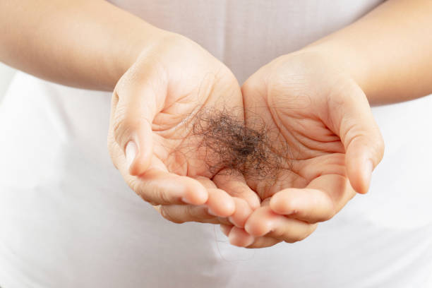 istock Women allergic to shampoo causing hair loss, baldness, dandruff 1325727872