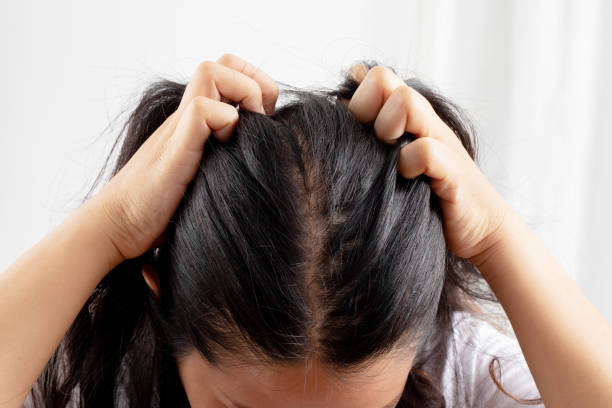 istock Women allergic to shampoo causing hair loss, baldness, dandruff 1325727874