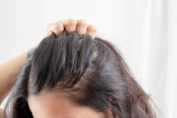 istock Women allergic to shampoo causing hair loss, baldness, dandruff 1325727913
