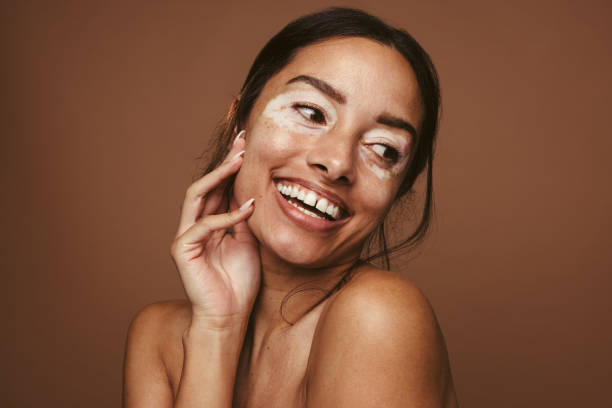 istock Woman with skin pigmentation 1325742102