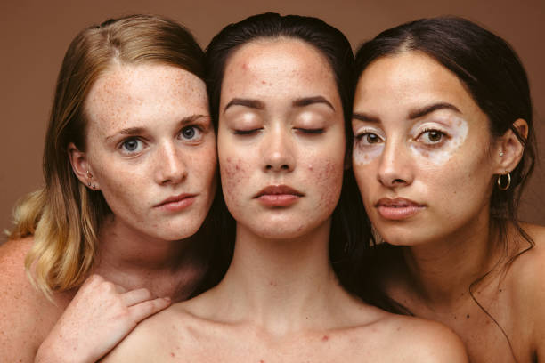 istock Woman with skin conditions 1325742143