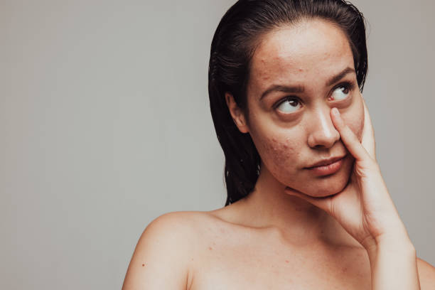 istock Woman frustrated about skin problems 1325742214